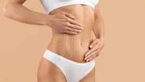 tummy tuck 